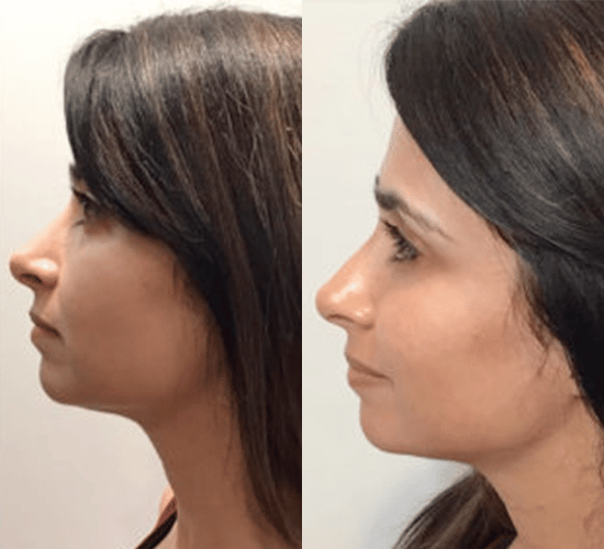 Fillers and Injectables Homepage Before and After Surgery in Newport Beach