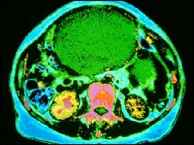 Tumor ovárico