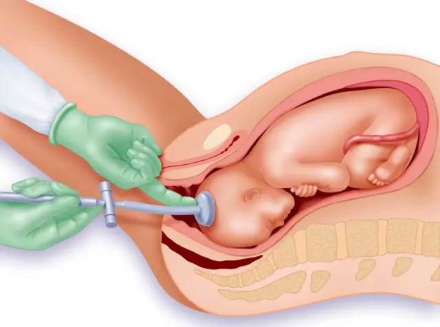 Ilustración de la venosa obstétrica, en la se ve como una copa de succión se pega a un bebé mientra para ayudarlo a salir por la vagina.